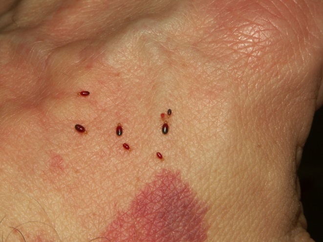 Description: Image result for bed bug bites to skins